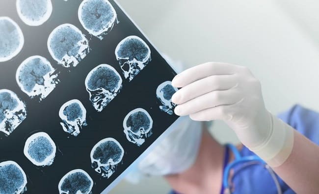 Ayuda a domicilio: ¿cómo superar un ictus II?